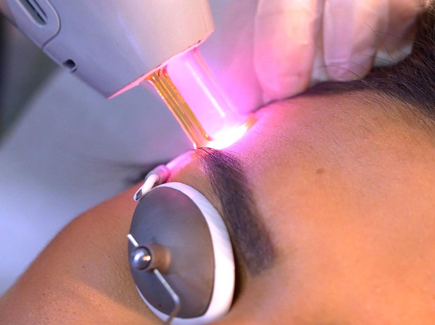 Eyebrow Laser Hair Removal: Reasons and Procedure