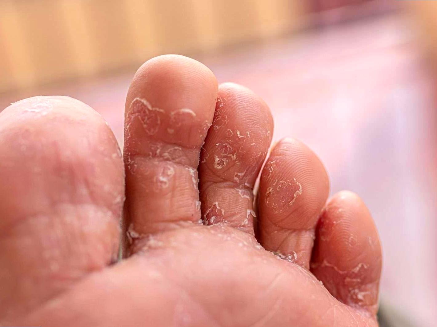 How to Treat and Prevent Athlete’s Foot