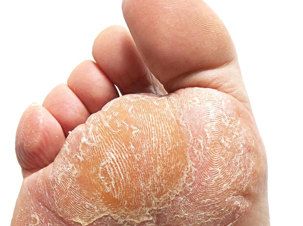 Strategies to Treat and Avoid Athlete's Foot