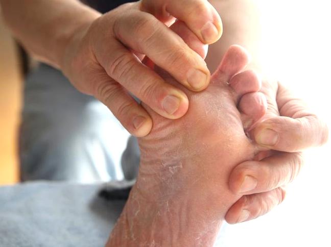 How to Care for and Prevent Athlete's Foot Issues