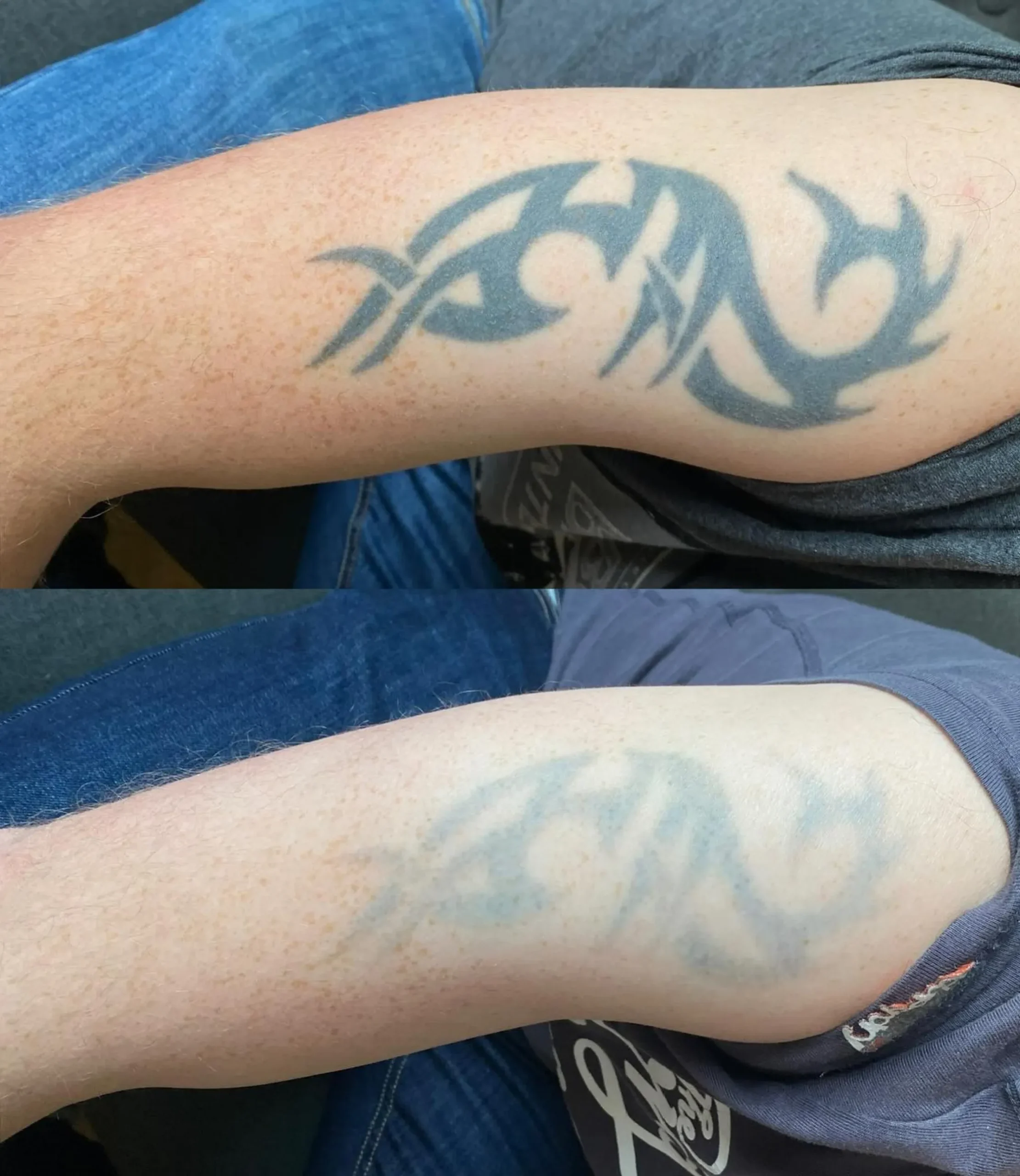 laser remove tattoo