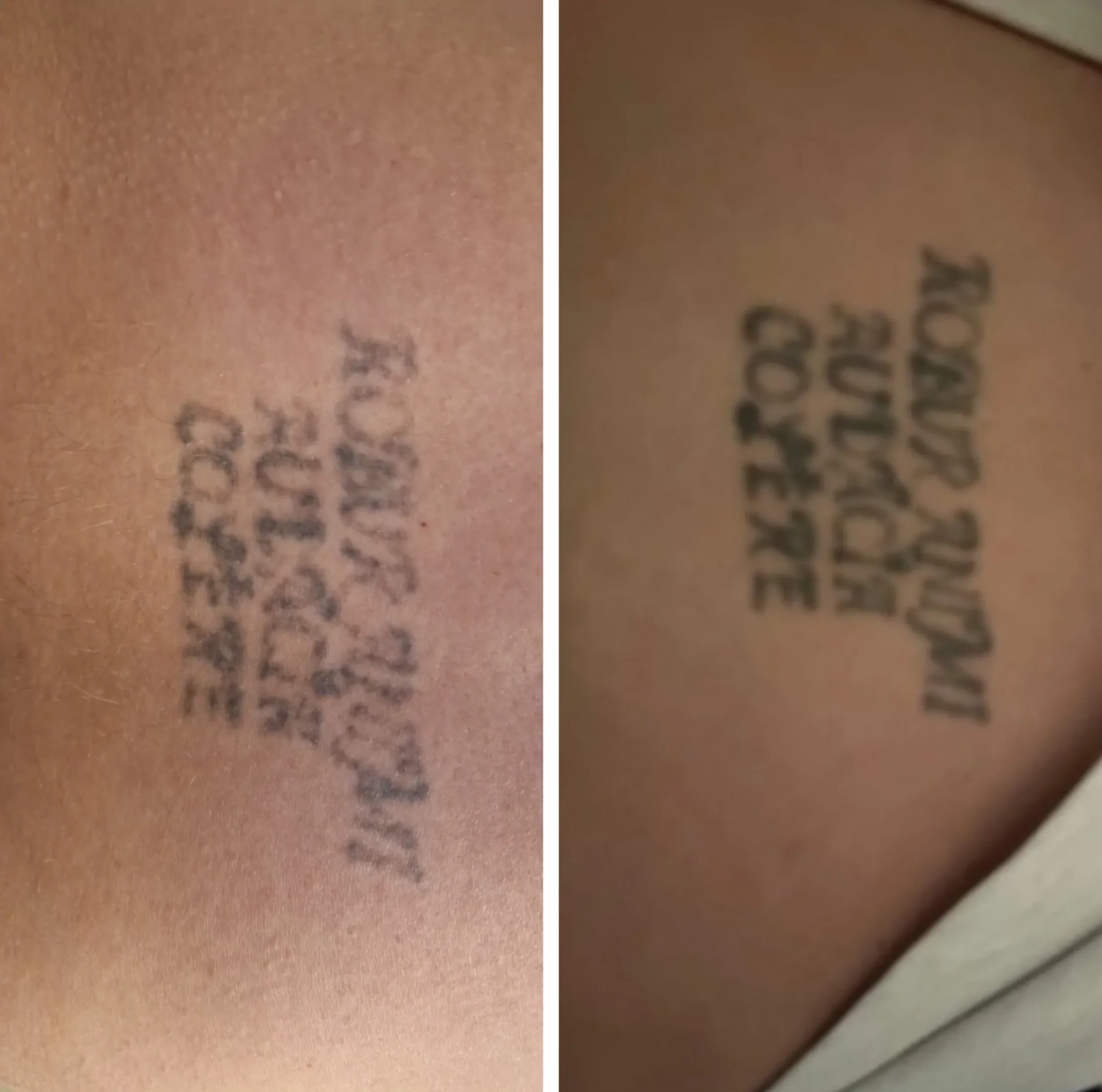 professional tattoo removal