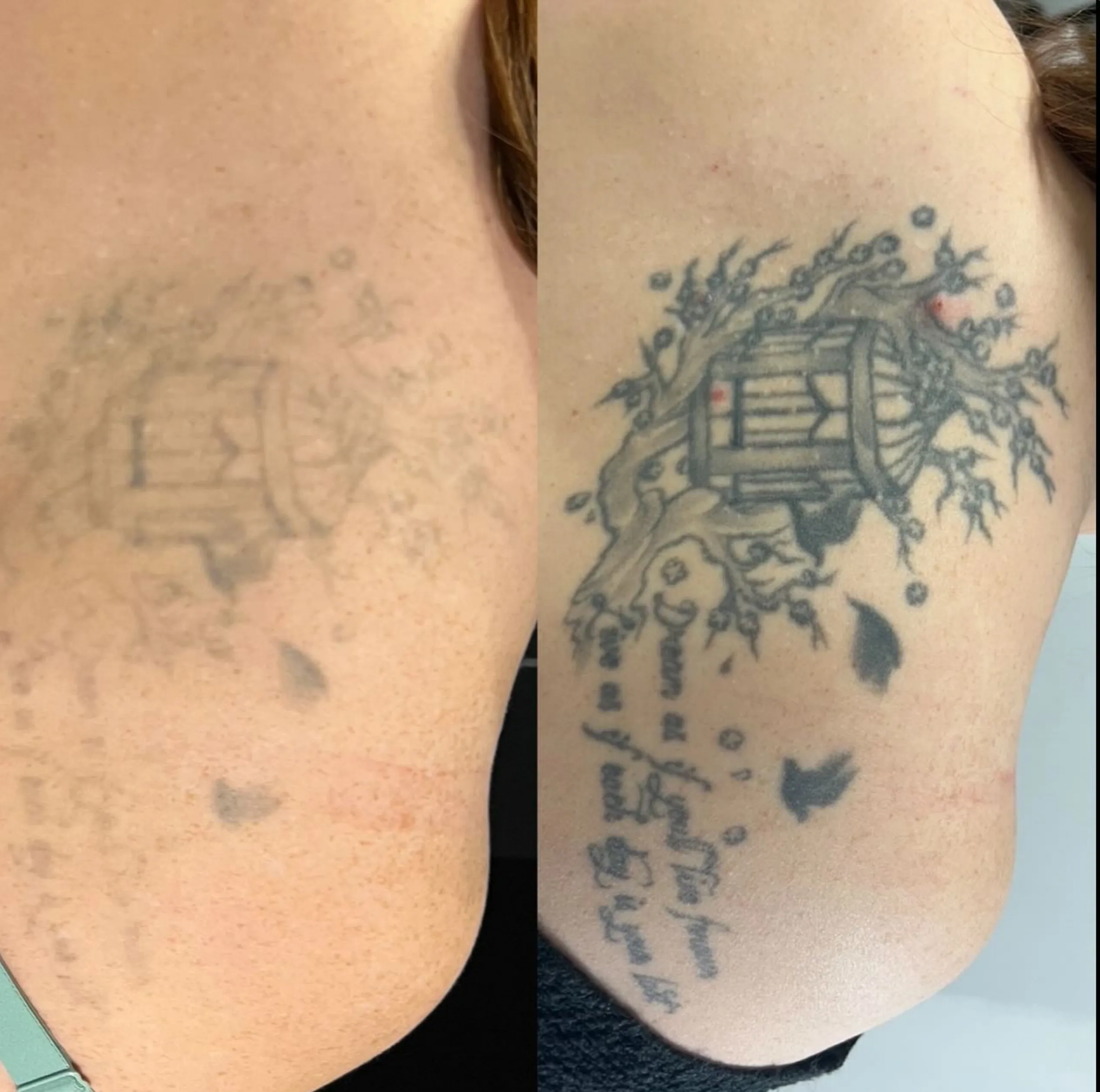 remove tattoo near me