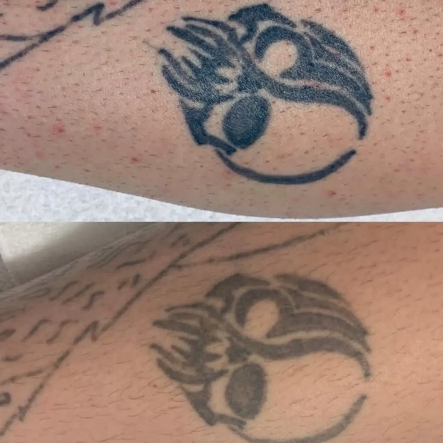 Can a Tattoo Be 100% Removed? Laser Tattoo Removal Explained