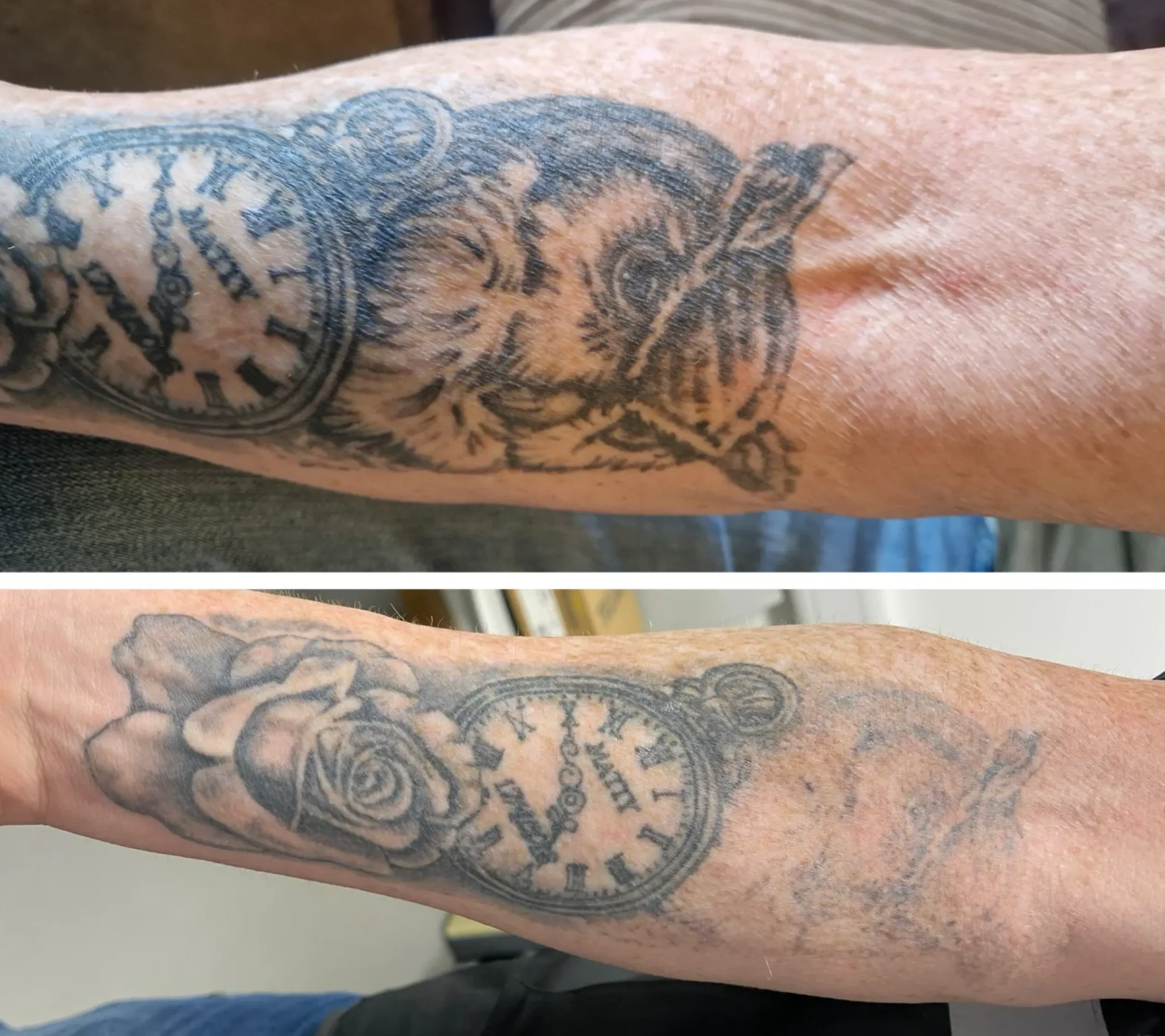 tattoo removal clinic melbourne